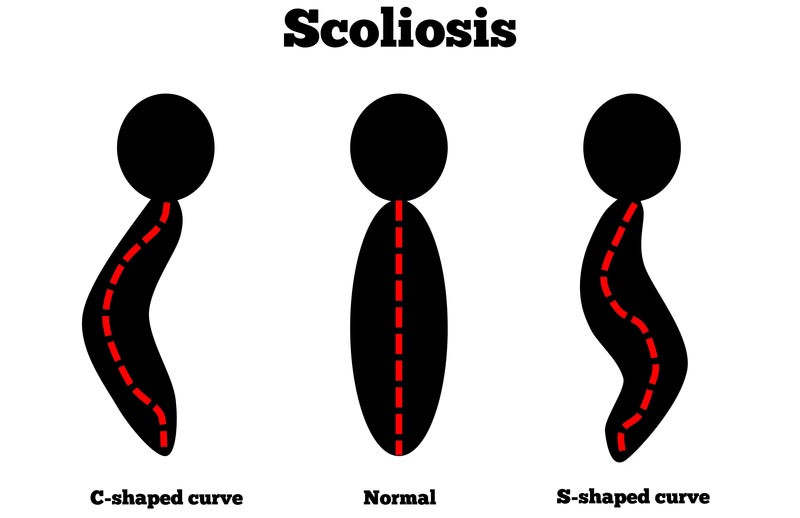 Louisville, KY scoliosis treatment